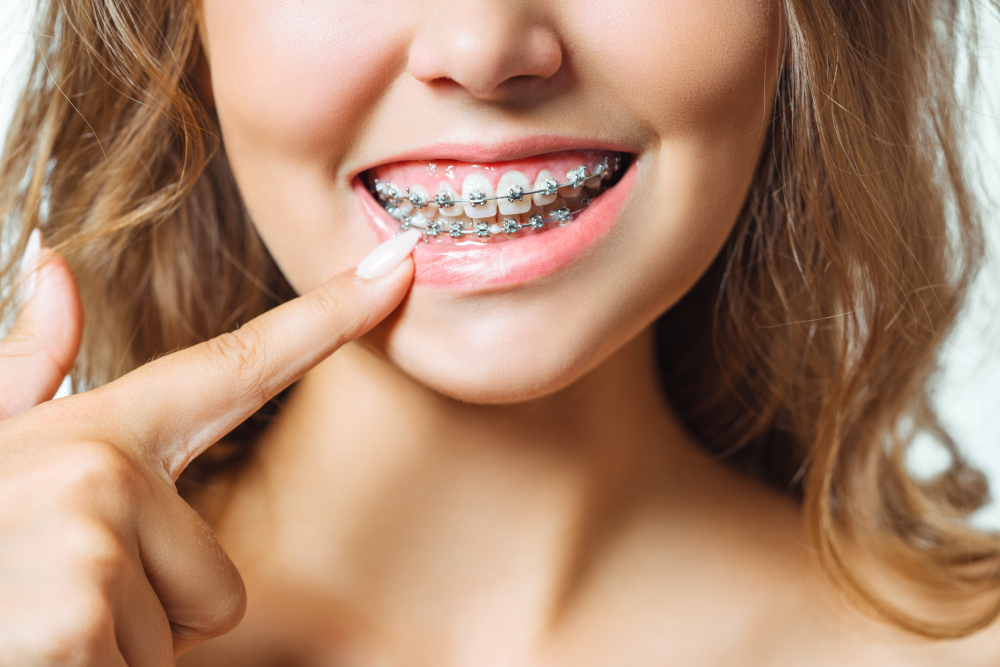 Orthodontic Care in Los Angeles