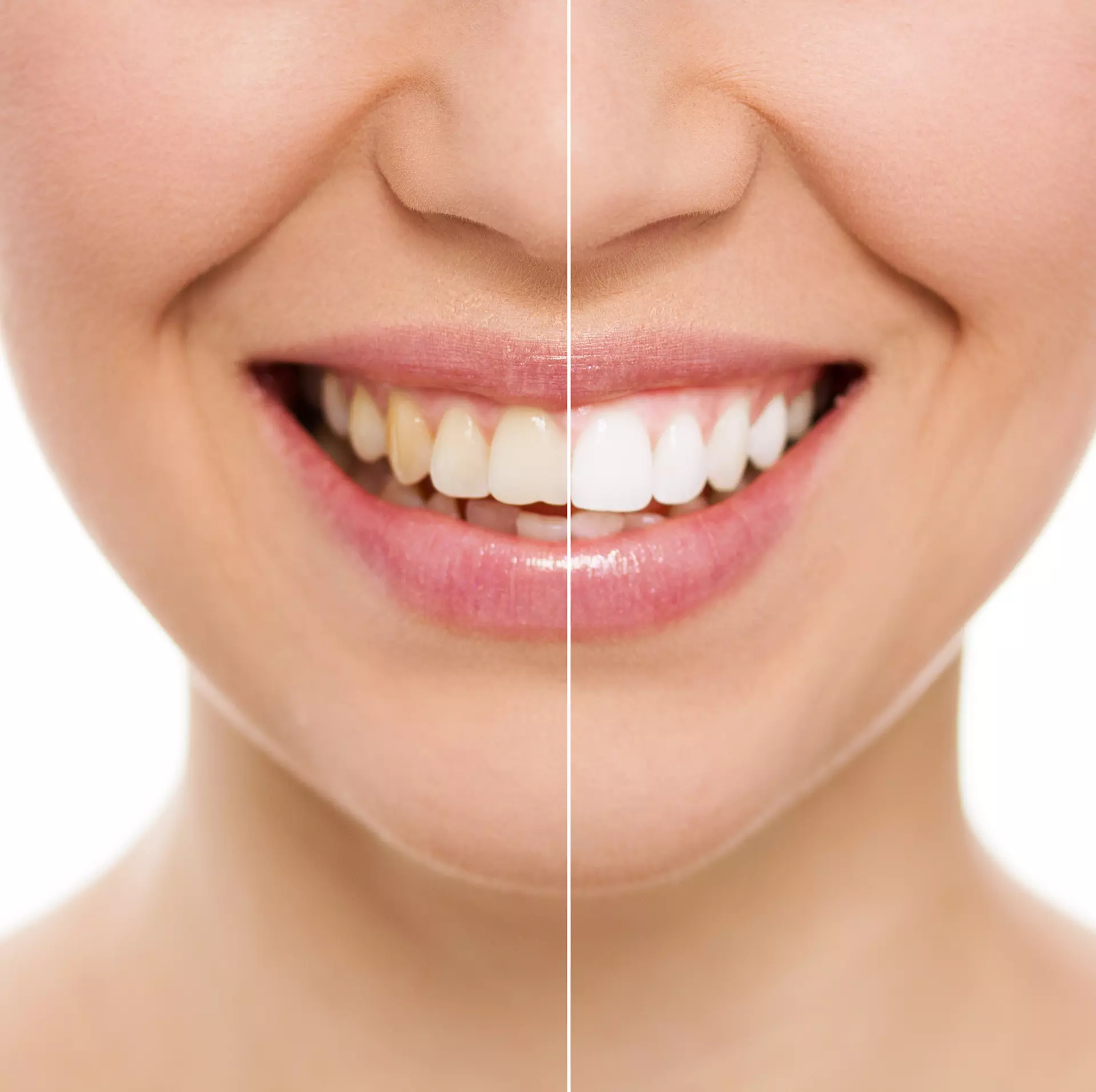 Teeth Whitening in Los Angeles